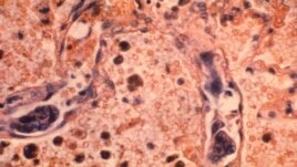 This 1964 microscope photo made available by the Centers for Disease Control and Prevention shows a lung tissue specimen from a patient with adenocarcinoma of the lung.