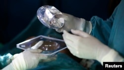 한 성형외과 의사가 환자의 가슴에 삽입할 보형물을 들고 있다. (자료사진)