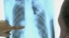 Effectiveness of Four-Drug TB Treatment Confirmed