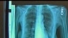 Tüberküloz Hastaları Akciğer Kanseri Riski Taşıyor