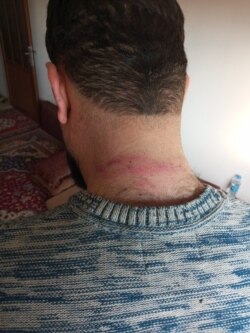 Syrian journalist Jindar Barakat, who was kidnapped and beaten Jan. 18, 2022, shows bruises on his neck. (Photo courtesy of Jindar Barakat)
