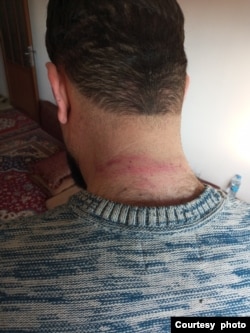 Syrian journalist Jindar Barakat, who was kidnapped and beaten Jan. 18, 2022, shows bruises on his neck. (Photo courtesy of Jindar Barakat)