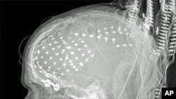 This is an X-ray showing electrodes that surgeons use to find and remove the source of seizures (to cure epilepsy), while sparing the source of mental functions like language. In this study, recordings when patients spoke words revealed that one small par