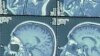 New Alzheimer's Guidelines Focus on Early Diagnosis