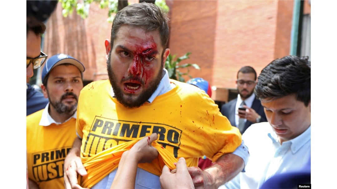 FILE - Juan Requesens, deputy of the Venezuelan coalition of opposition parties (MUD), is helped after being injured in clashes with pro-government supporters outside the offices of the Venezuela's ombudsman in Caracas, Venezuela, April 3, 2017.