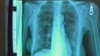 Bệnh phổi mạn tính có thể làm tăng nguy cơ ung thư phổi