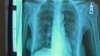 FILE - A high-tech X-ray, called a CT scan, can see whether current and former smokers are developing lung cancer. However, more invasive testing is necessary to determine if nodules are malignant.
