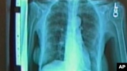 FILE - A high-tech X-ray, called a CT scan, can see whether current and former smokers are developing lung cancer. However, more invasive testing is necessary to determine if nodules are malignant.