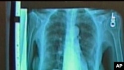 Lung cancer sufferers whose disease was discovered by CT scans, as opposed to x-rays, have a better survival rate, according to a new study from the National Cancer Institute.