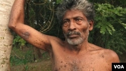 Manatosh Biswas, 51, from Teghoria village in theNorth 24 Paraganas district of West Bengal, is suffering from Bowen’s Disease- a pre-cancerous condition. (M. Hussain/VOA)