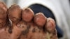 A resident of Kamuli district in eastern Uganda, displays her foot, infested by jiggers. (File Photo)