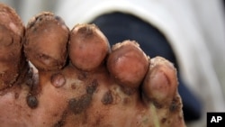 A resident of Kamuli district in eastern Uganda, displays her foot, infested by jiggers. (File Photo)