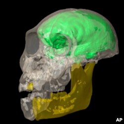 The yellow color in this scan of the young male brain cavity indicates portions of the skull that were reconstructed by mirror-imaging the anatomy on the opposite side.