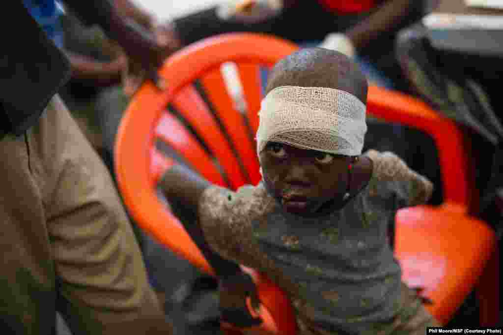 A girl is treated for burns in the Médecins Sans Frontières (MSF) clinic set up at the camp for displaced people in the grounds of the United Nations Mission to South Sudan (UNMISS) base in Juba, South Sudan, on January 12, 2014.