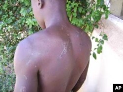 A Zimbabwean farm laborer shows the scars of an attack on him by so-called “war veterans” supporting President Robert Mugabe
