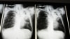 FDA Loloskan Obat Tuberkulosis Baru dalam 40 Tahun 