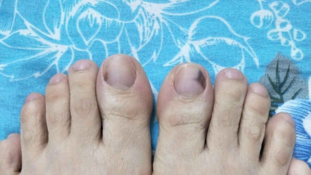 Vết đen dưới móng chân không phải lúc nào cũng là dấu hiệu của bệnh móng chân thâm đen. Tuy nhiên, nếu bạn phát hiện ra điều này, hãy tìm hiểu ngay để phòng tránh tình trạng bệnh tật nguy hiểm. Hãy nhấp vào hình ảnh để biết thêm chi tiết.