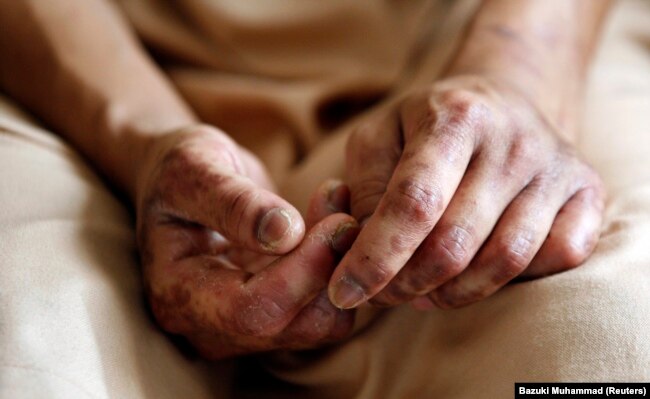 Tangan Sri Lestari Wagiyo (19 tahun), TKW Indonesia asal Jawa Timur yang dianiaya majikannya di Malaysia, saat diwawancarai di tempat penampungan sementara di Kuala Lumpur, 5 November 2009. (REUTERS/Bazuki Muhammad)