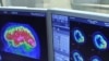Новый метод томографии выявляет малые травмы мозга