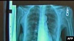 Chụp CT giảm tử vong vì ung thư phổi