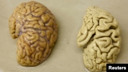 FILE - One hemisphere of a healthy brain (L) is pictured next to one hemisphere of a brain of a person suffering from Alzheimer disease.