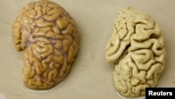 نیمه مغز سالم در کنار نیمه مغز یک بیمار مبتلا به آلزایمر (راست)