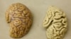 نیمه مغز سالم (چپ) در کنار نیمه مغز فرد مبتلا به آلزایمر