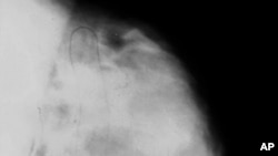 The mammogram of a breast with lots of fatty tissue (the opposite of dense) appears noticeably darker, so light tumors would show up better against that background. 