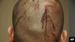 This Feb. 27, 2012 photo released by the State Attorney's Office shows George Zimmerman, the neighborhood watch volunteer who shot Trayvon Martin, with blood on the back of his head. 