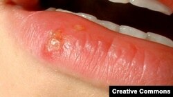 Grâce à l'herpès qui provoque les boutons de fièvre au lèvres, des chercheurs ont pu confirmer l'origine africaine des être humains