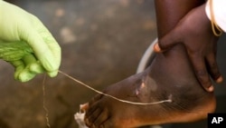 FILE - A Guinea worm is extracted from a child's foot at a containment center in Savelugu, Ghana, March 9, 2007.