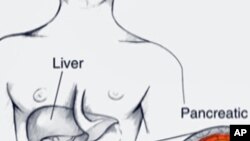 Scientists at Fred Hutchinson Cancer Research Center report they've found a way to break through the unique biological barrier a pancreas cancer tumor builds around itself in mice. 