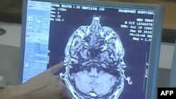 Një mënyrë për diagnostikimin e saktë të sëmundjes së Alzheimerit