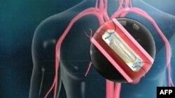 Senzor ugrađen u srčanu pulmonarnu arteriju