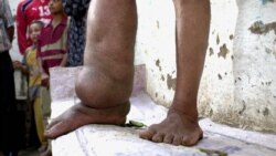 Can Treated Mosquito Net Stop Elephantiasis?