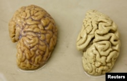 One hemisphere of a healthy brain (L) is pictured next to one hemisphere of a brain of a person suffering from Alzheimer disease.