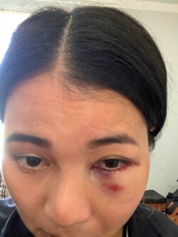 Mantakarn Seenin, A Thai woman shows her wounds on her face caused by brutally attacked while riding the BART train in San Francisco, CA.
