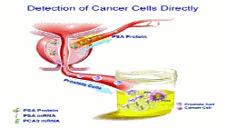 Kanceri i prostatës dhe analiza PSA