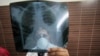FILE - A physician examines an X-ray picture of a tuberculosis patient.