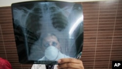 FILE - A physician examines an X-ray picture of a tuberculosis patient.