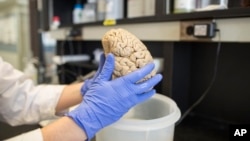 FILE - A researcher holds a human brain in a laboratory in Chicago, July 29, 2013. Brain-imaging shows a lot of harmful inflammation in the brains of Alzheimer's patients.