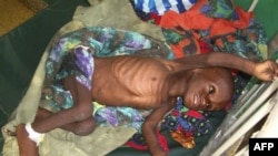 Trẻ bị suy dinh dưỡng đang được chữa trị tại một bệnh viện trong thủ đô Mogadishu của Somalia