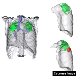 Rendering of a CT scan of a patient with extensively drug-resistant tuberculosis. Credit: Clifton Barry, NIAID