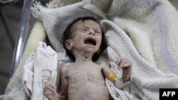 FILE - A Syrian infant suffering from severe malnutrition is seen at a clinic in Hamouria, Eastern Ghouta, a suburb of Damascus, Syria, Oct. 21, 2017.