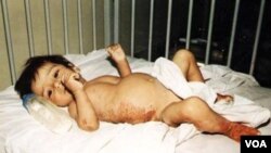 Sardasht Chimical Attack