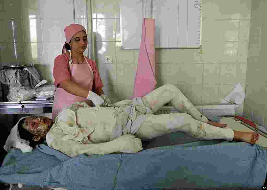 Afghan patient Parwin, 23, a mother of three children and pregnant for three months receives medical treatment at the burn unit of Isteqlal hospital, after she committed self immolation, in Kabul. Parwin covered herself in kerosene before setting fire to 