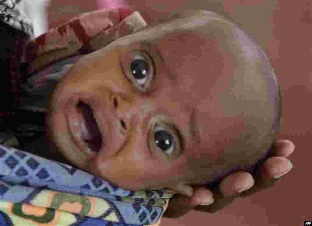 A malnourished Somalia refugee child is seen at a field hospital of the International Rescue Committee, IRC, in Dadaab, Kenya, Wednesday, Aug. 3, 2011. Dadaab, a camp designed for 90,000 people now houses around 440,000 refugees. Almost all are from war
