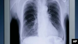 El estudio puede ayudar a entender cómo evoluciona el cáncer de pulmón.