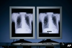 Công nghệ OnGuard Chest X-ray CAD (computer-aided detection) của công ty Riverain phát hiện các cục u bướu hạch nhỏ đáng nghi có thể là dấu hiệu của ung thư phổi giai đoạn sớm giúp cải thiện tỷ lệ sống sót cho các bệnh nhân. (PRNewsFoto/Cleveland Clinic and Riverain Medical)