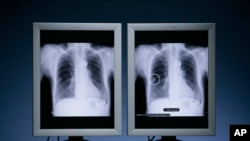 FILE - Riverain's OnGuard Chest X-ray CAD (computer-aided detection) technology detects suspicious nodules that may be early-stage lung cancer, leading to improved patient survival rates, Nov. 20, 2007. (PRNewsFoto/Cleveland Clinic and Riverain Medical)